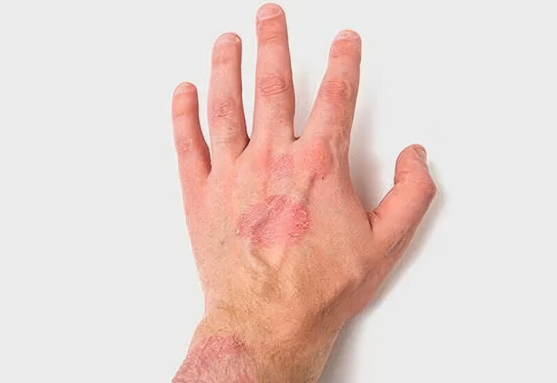 Кожа склонная к атопии