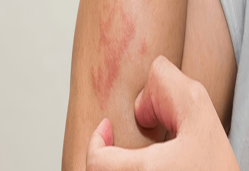 Кожа склонная к атопии