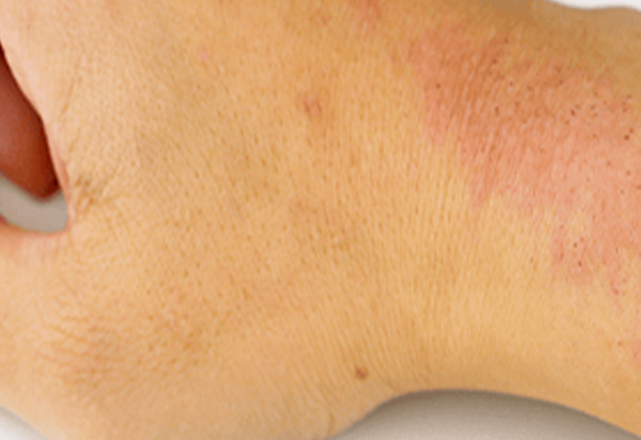 Кожа склонная к атопии