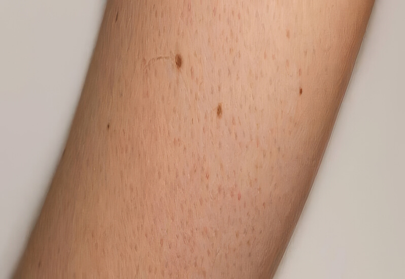 Грубая и шелушащаяся кожа