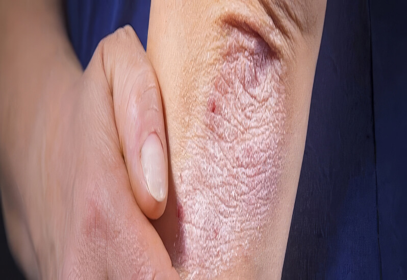 Кожа склонная к атопии