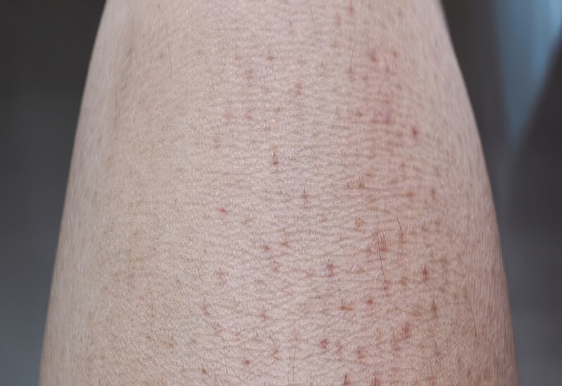 Грубая и шелушащаяся кожа